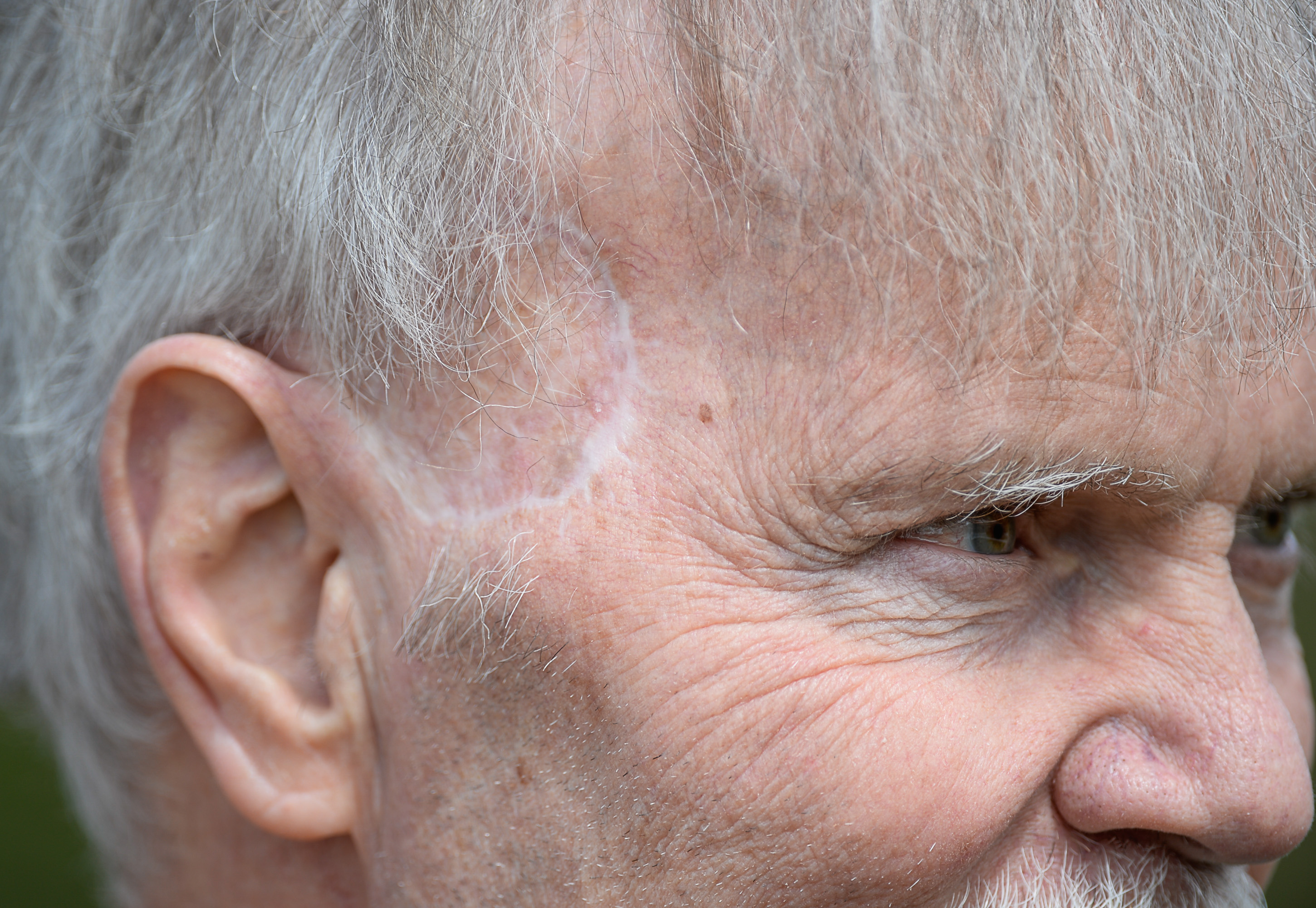 (Francisco Kjolseth | The Salt Lake Tribune) Long time runner Rick Ortenburger of Draper, plans to run the Salt Lake Marathon 10k on Saturday just before his 9th infusion of immunotherapy after being diagnosed with melanoma and receiving a skin graft in July. He and his wife are part of a group that raises money for cancer research, specifically for the Hunstman Cancer Center, both competing in various events throughout the year, but this year is special as Rick puts on his running shoes once again following this challenging period in his life.